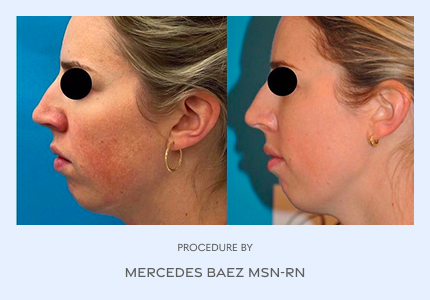 Before and After