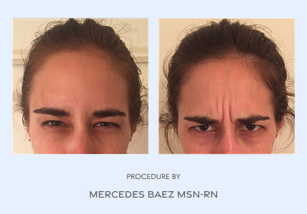 Before and After