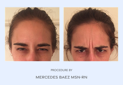 Before and After
