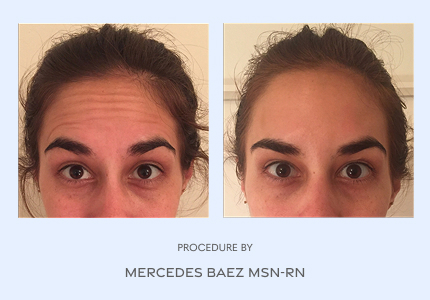 Before and After
