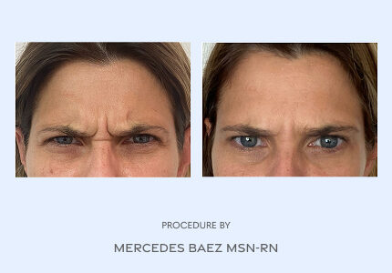 Before and After