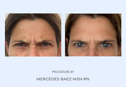 Before and After