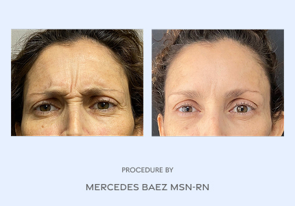 Before and After