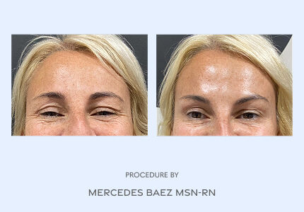 Before and After