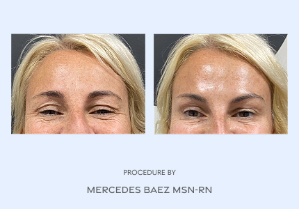 Before and After