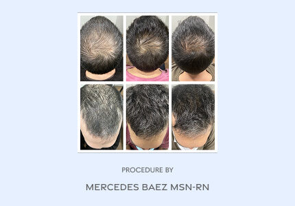 Before and After