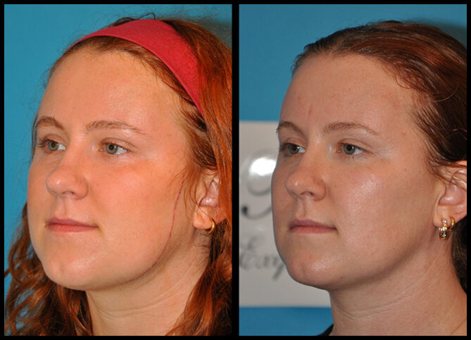 Before and After