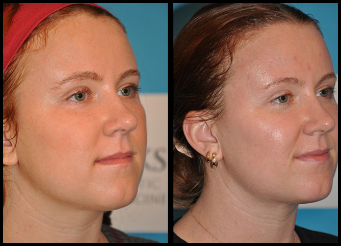 Before and After