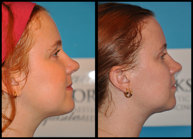 Before and After