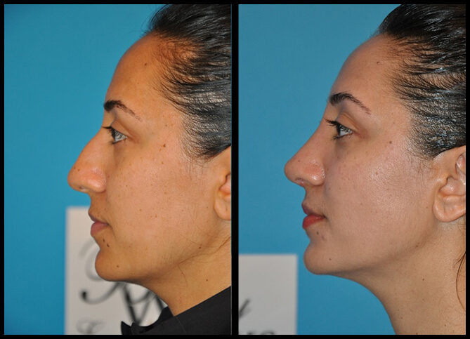 Before and After