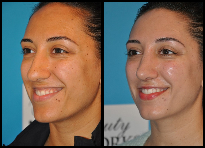 Before and After