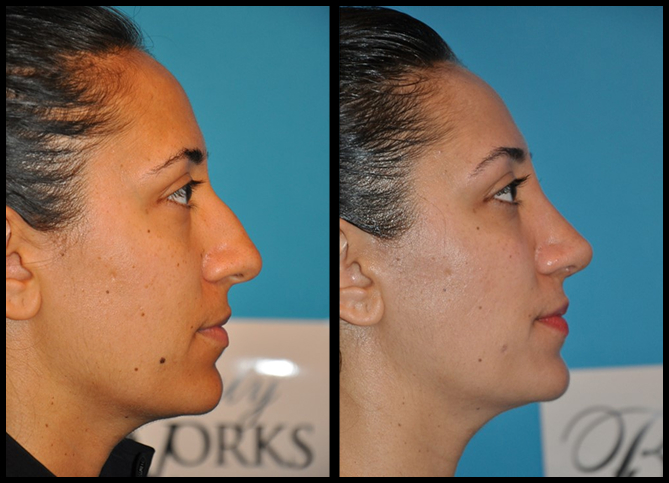 Before and After