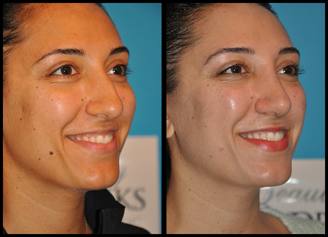 Before and After