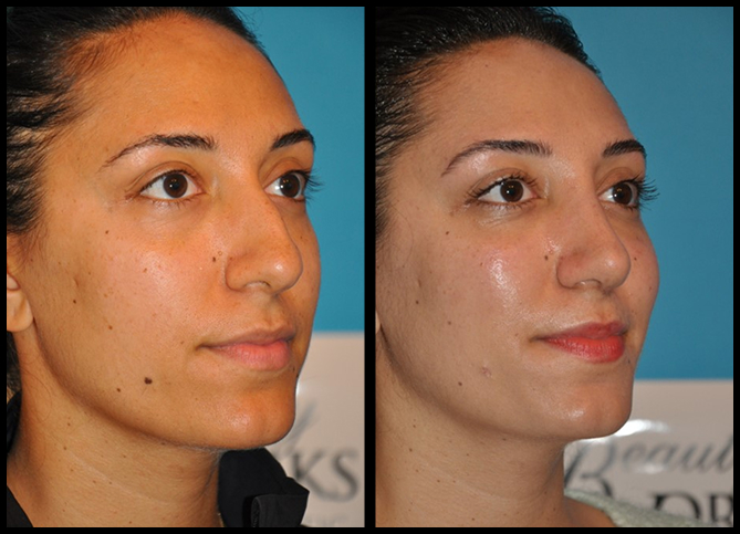 Before and After