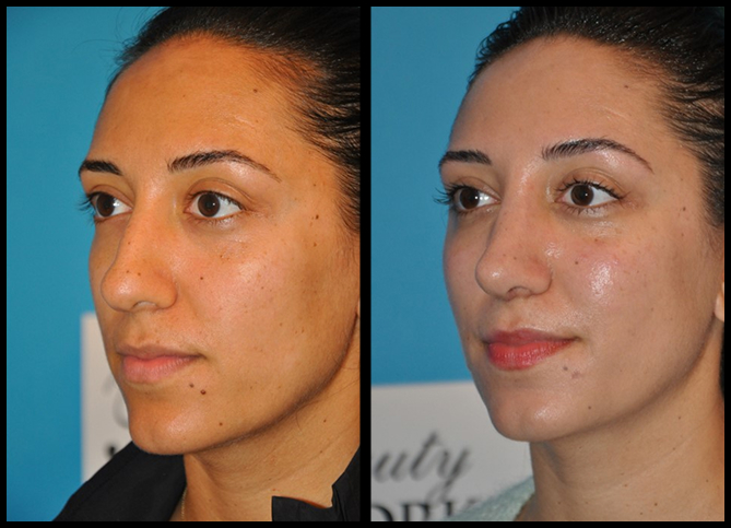 Before and After