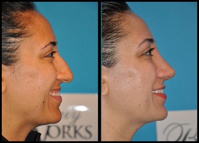 Before and After