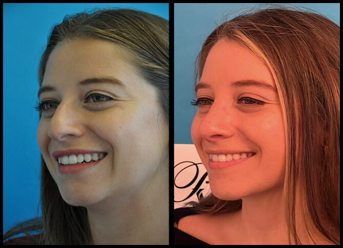 Before and After