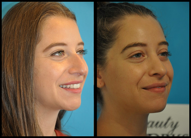 Before and After