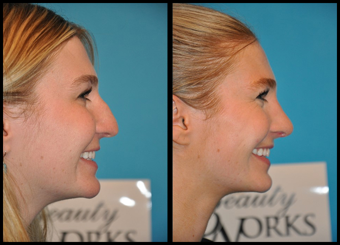 Before and After