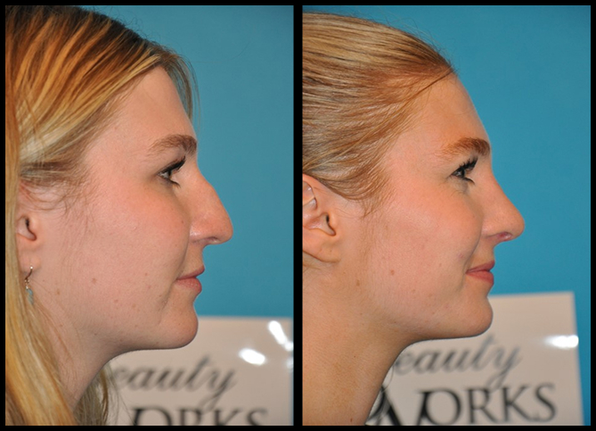 Before and After