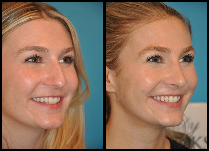Before and After