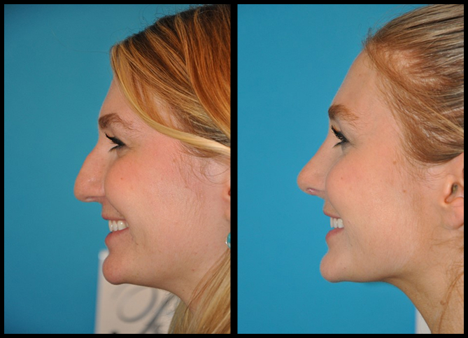 Before and After