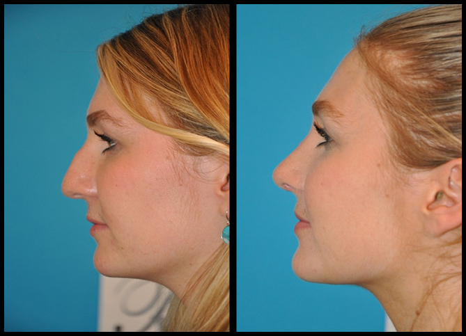 Before and After