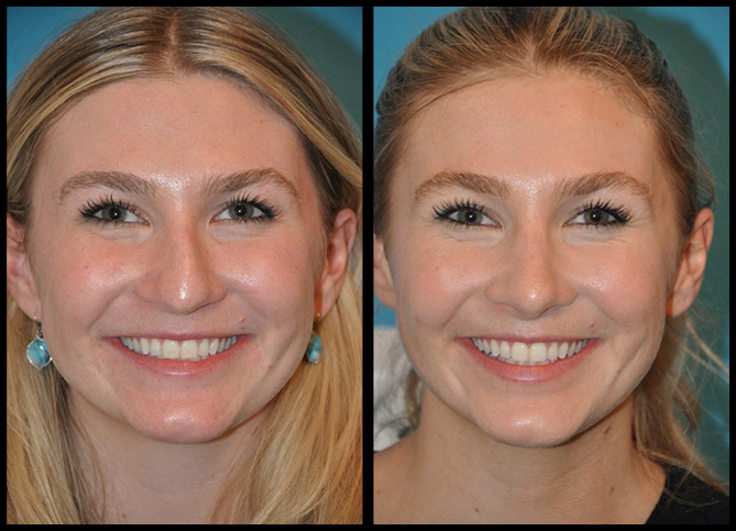 Before and After