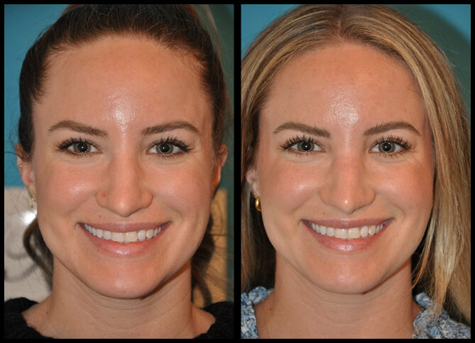 Before and After