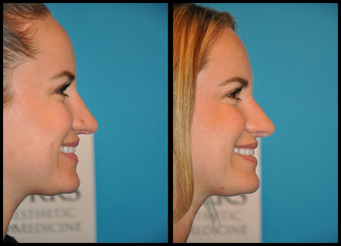 Before and After