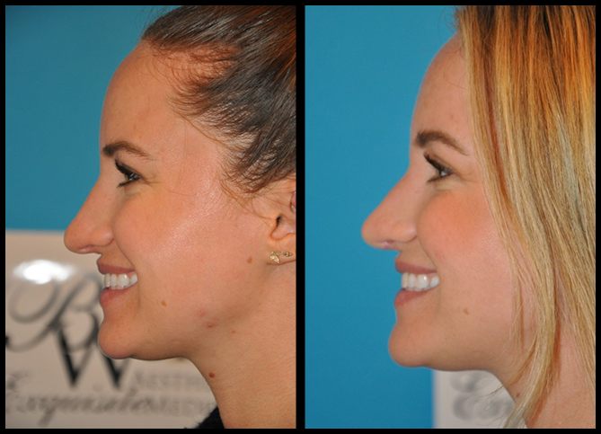Before and After