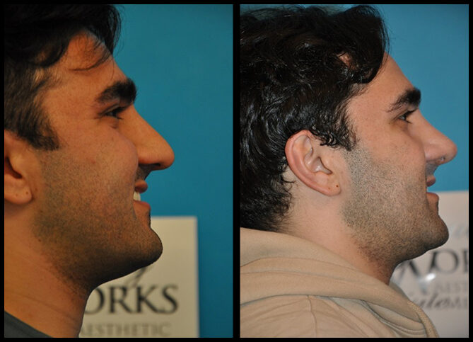 Before and After