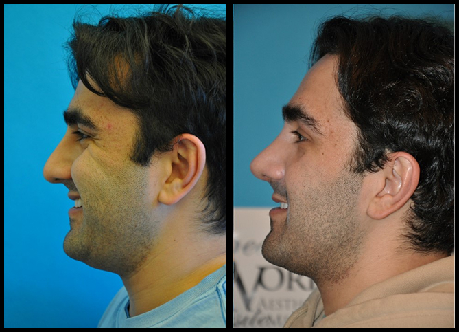 Before and After