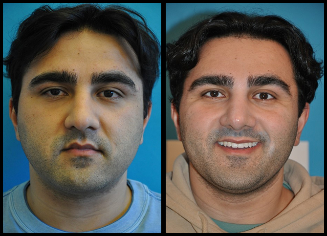 Before and After