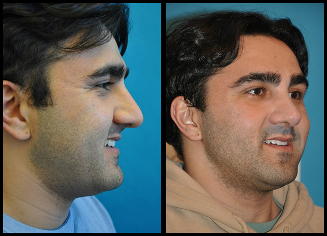 Before and After