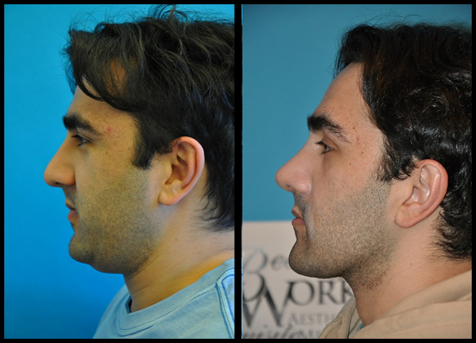 Before and After