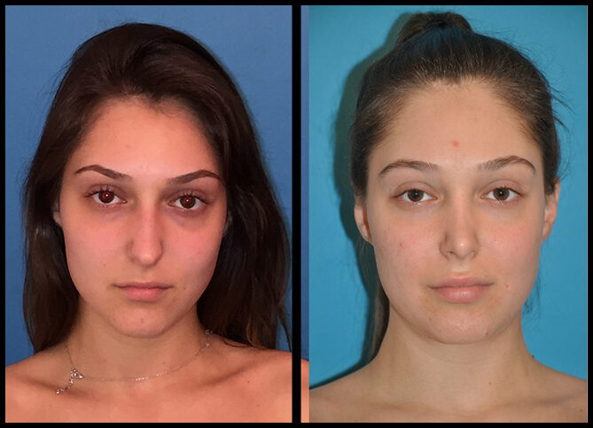 Before and After