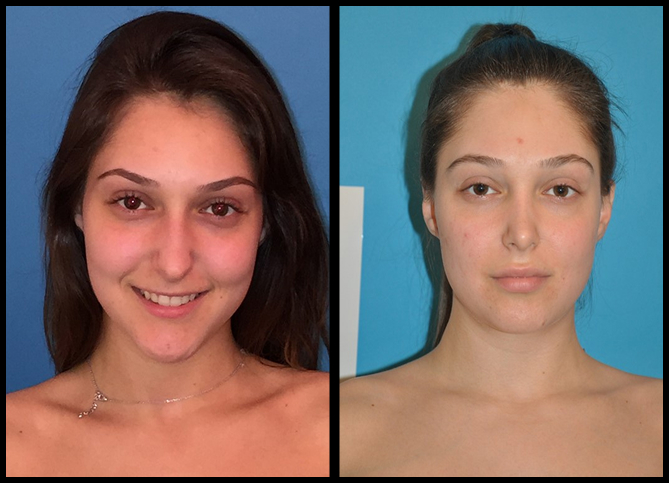 Before and After