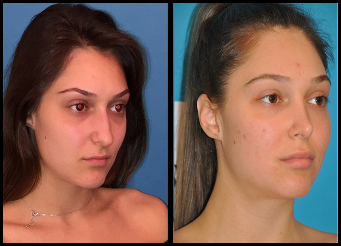 Before and After
