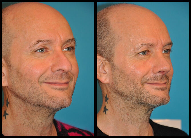 Before and After