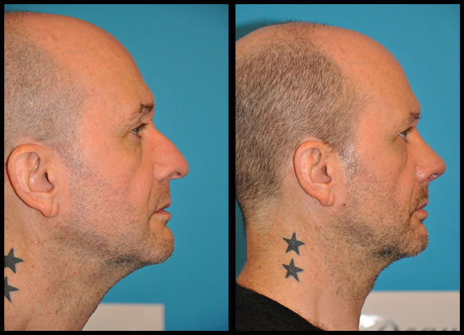 Before and After