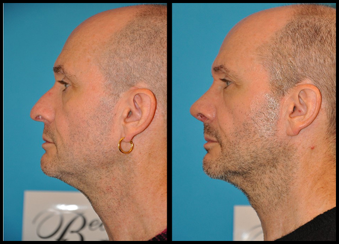 Before and After