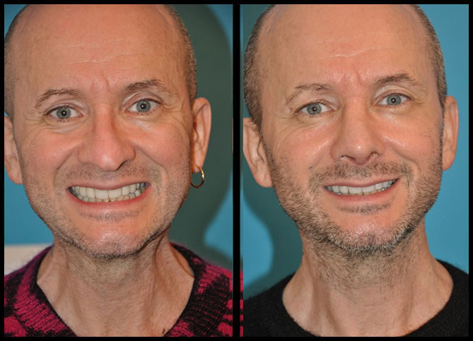 Before and After