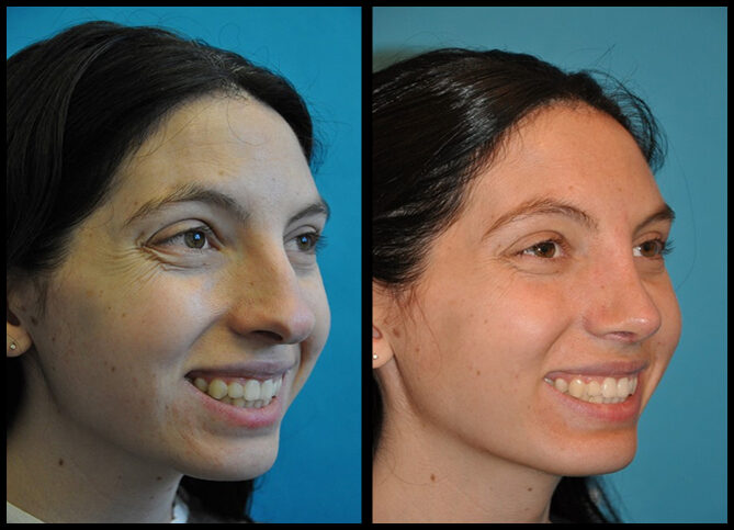 Before and After