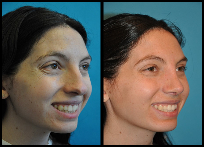 Before and After