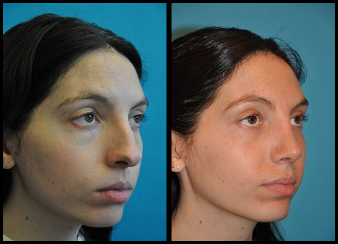 Before and After