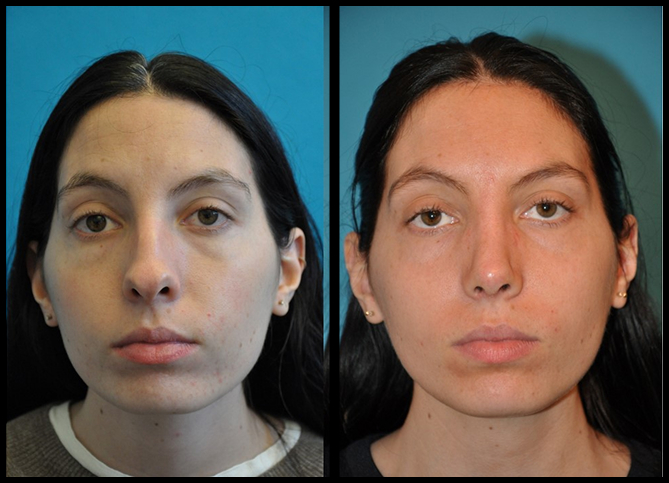 Before and After
