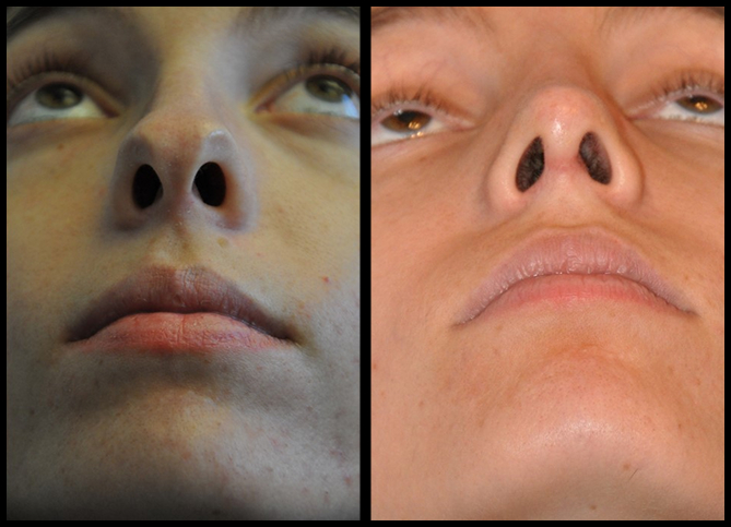 Before and After