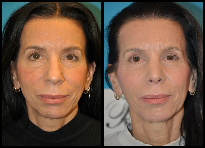 Before and After
