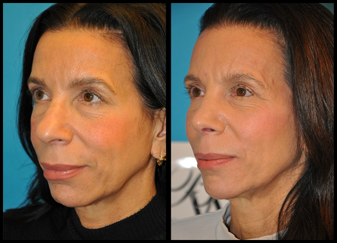 Before and After